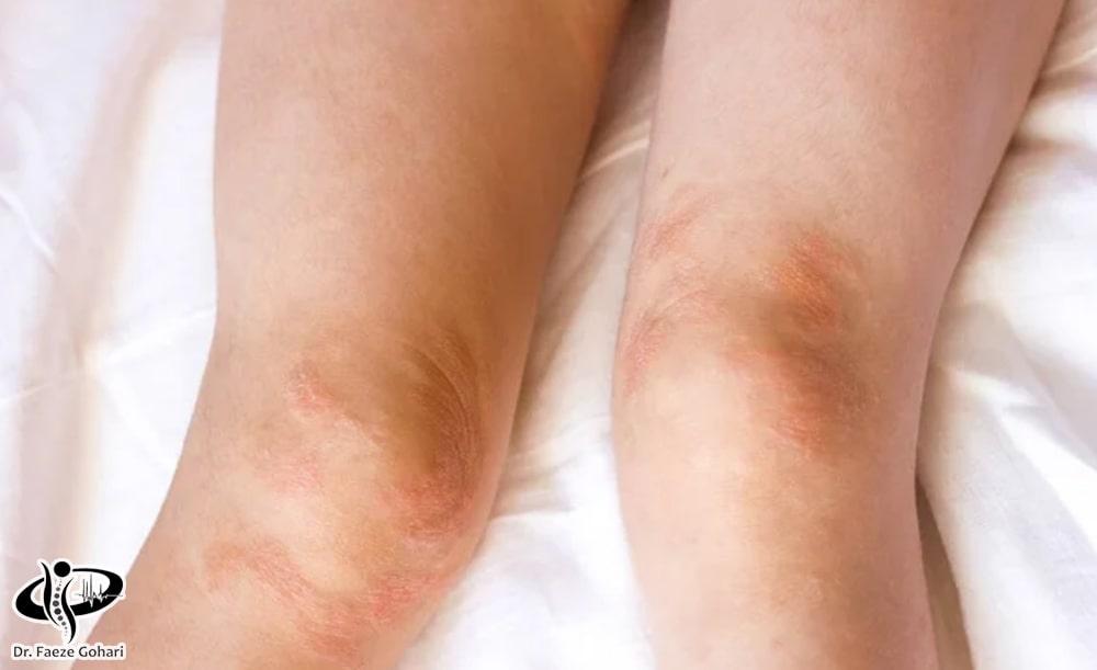 واکنش‌های آلرژیک 