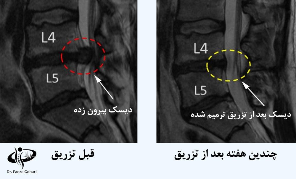 مزایای تزریق سلولهای بنیادی به همراه PRP