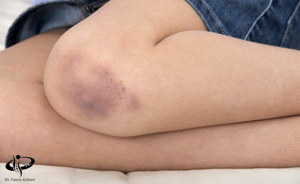 کبودی یا هماتوم در محل برداشت سلول یا تزریق 