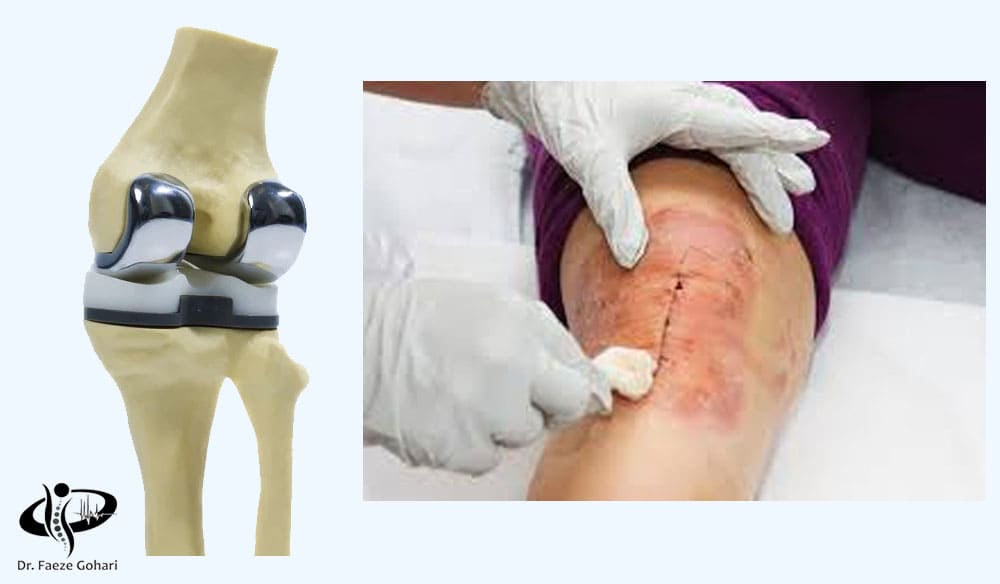 آسیب غضروفی