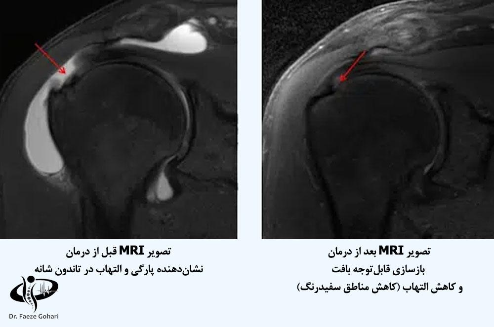 درد مزمن شانه 