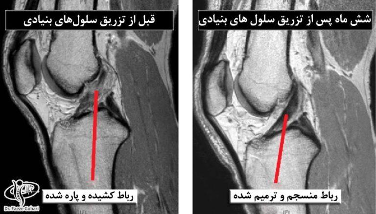 پارگی رباط صلیبی