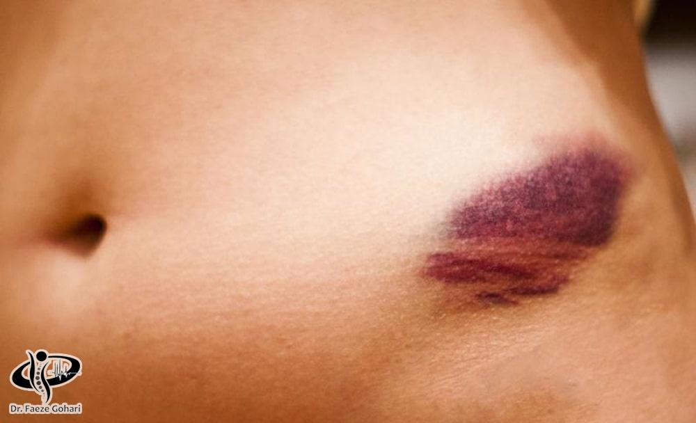 آسیب به بافت‌های اطراف در محل برداشت سلول‌های بنیادی 