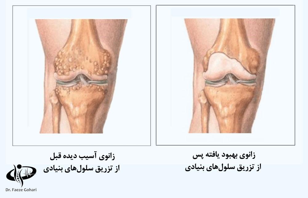 زانوی بهبود یافته پس از تزریق سلولهای بنیادی