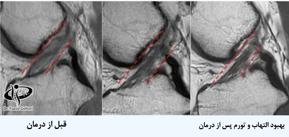 بهبود التهاب و تورم زانو پس از درمان