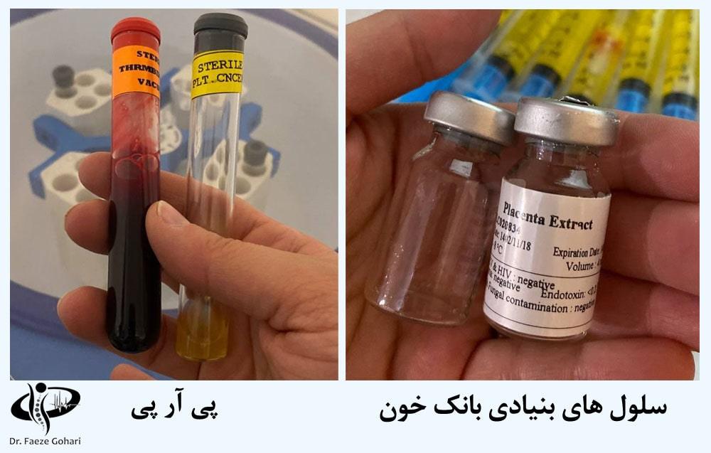 تزریق پی آر پی و سلول های بنیادی به زانو