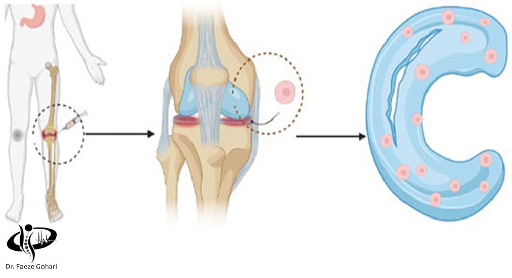 آسیب به مینیسک زانو