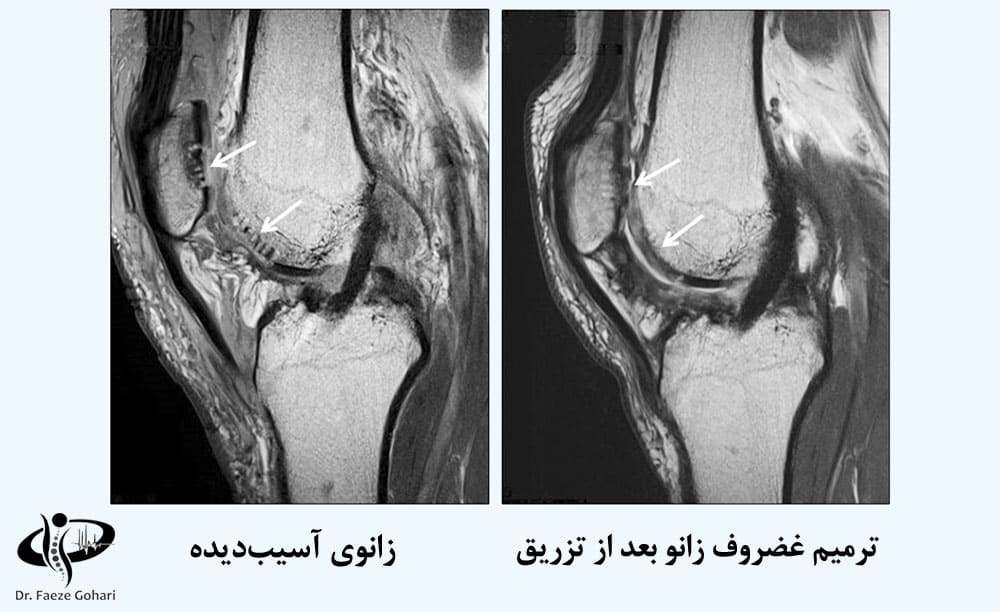 ترمیم غضروف زانو بعد از تزریق