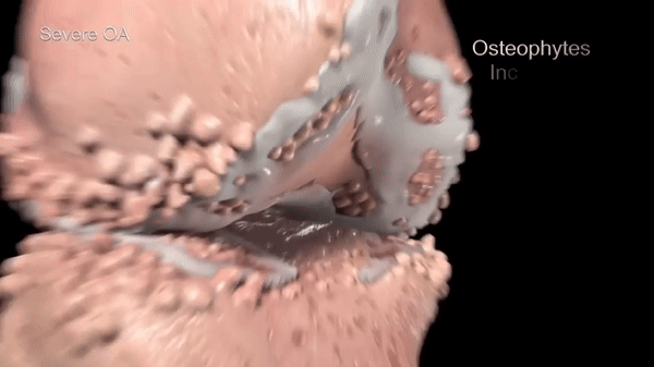 آرتروز متوسط تا شدید