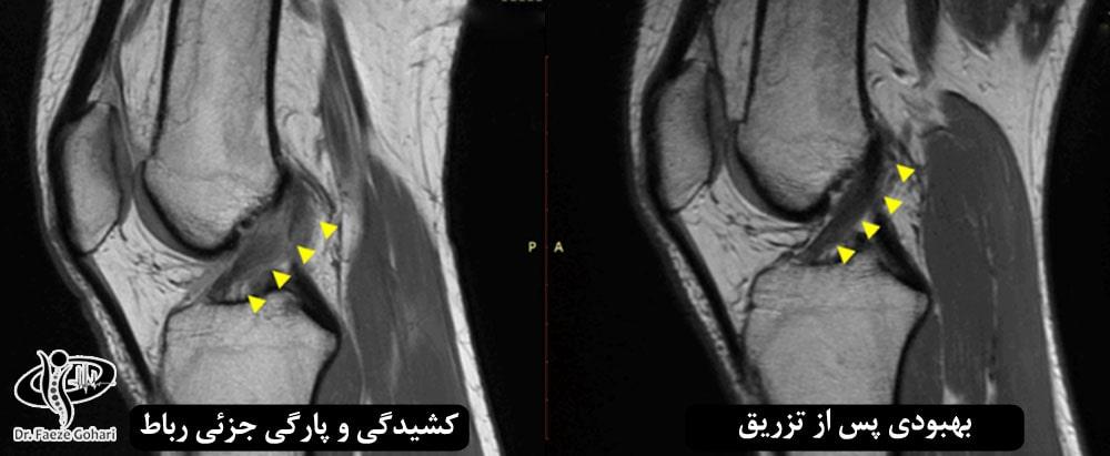بهبودی پس از تزریق