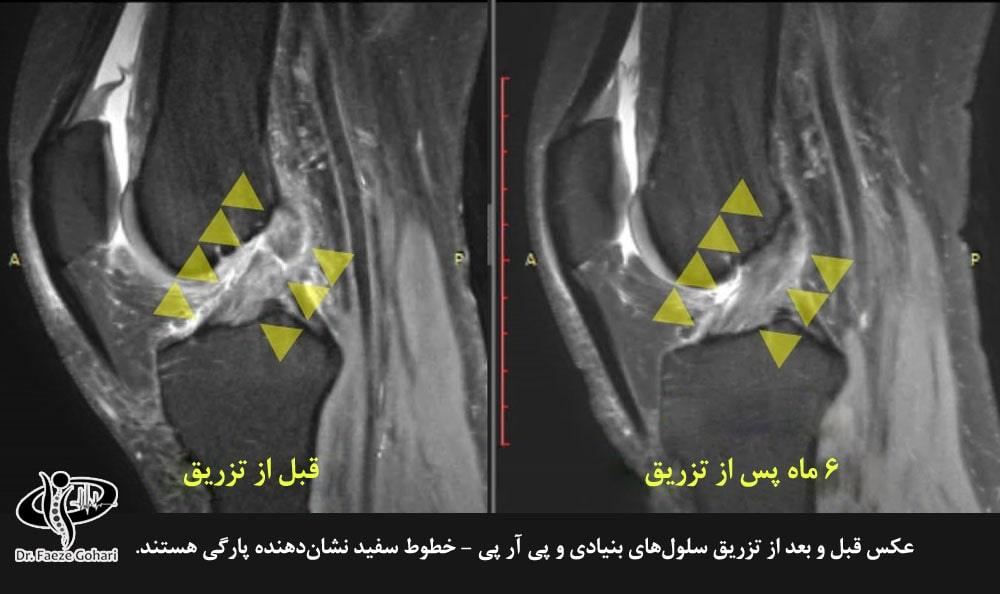 تزریق سلولهای بنیادی پس از جراحی ترمیم رباط صلیبی