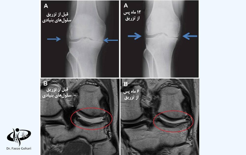 درمان آرتروز زانو با سلولهای بنیادی