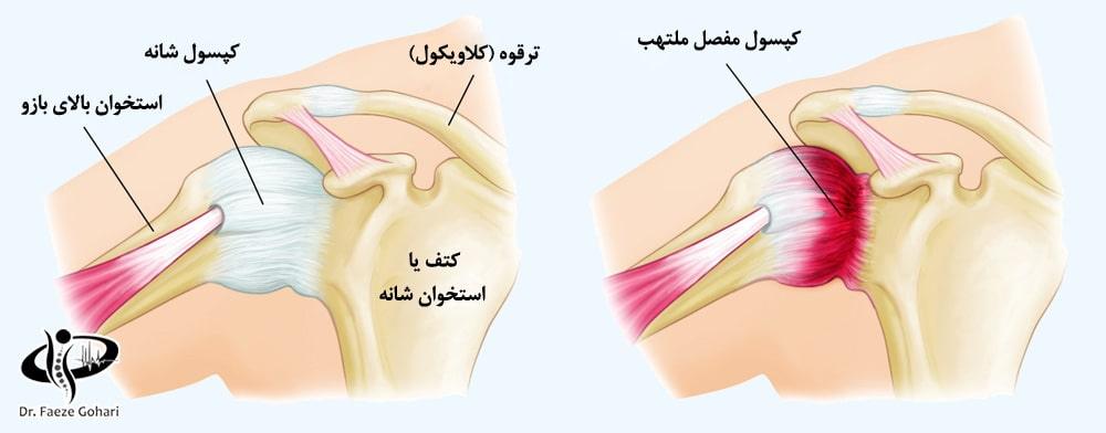 کپسولیت چسبنده یا «شانه یخزده»