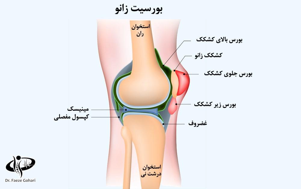 آمپول برای بورسیت مزمن