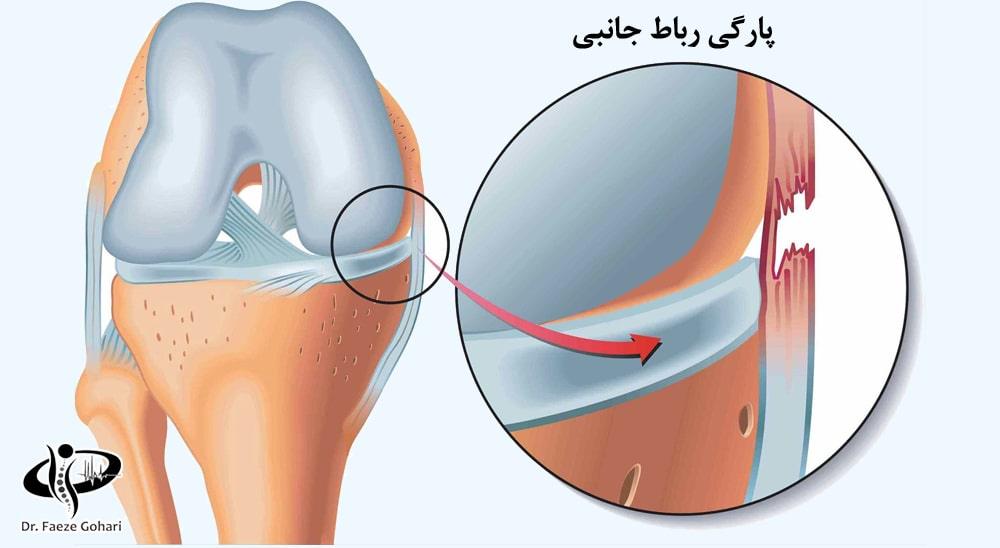 آمپول برای پارگی مزمن رباط