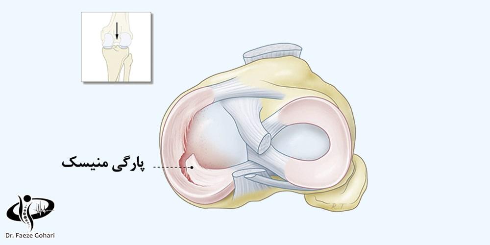 آمپول برای پارگی مزمن مینیسک زانو