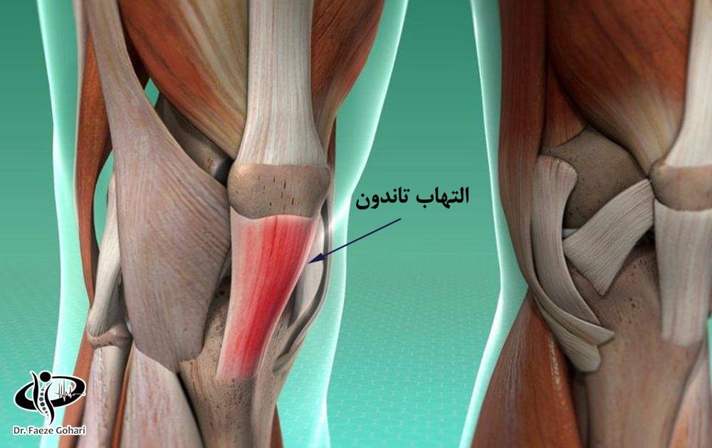 آمپول برای التهاب تاندون مزمن