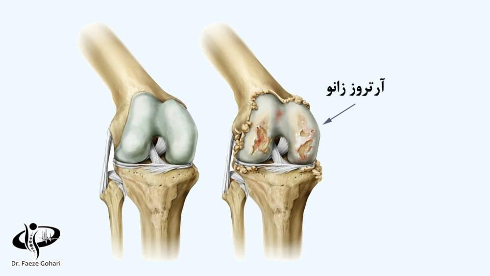 آمپول برای آرتروز زانو