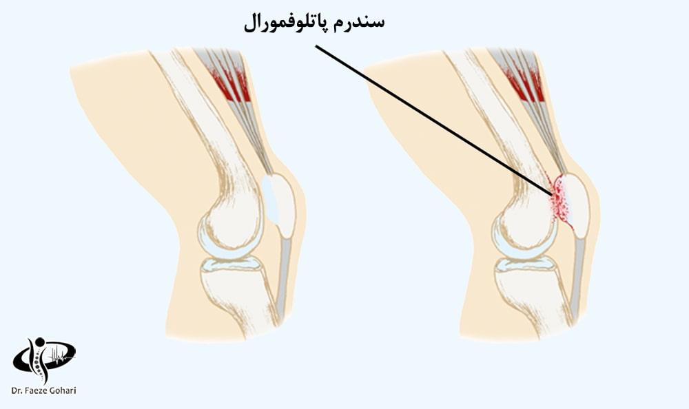 آمپول برای سندرم پاتلوفمورال