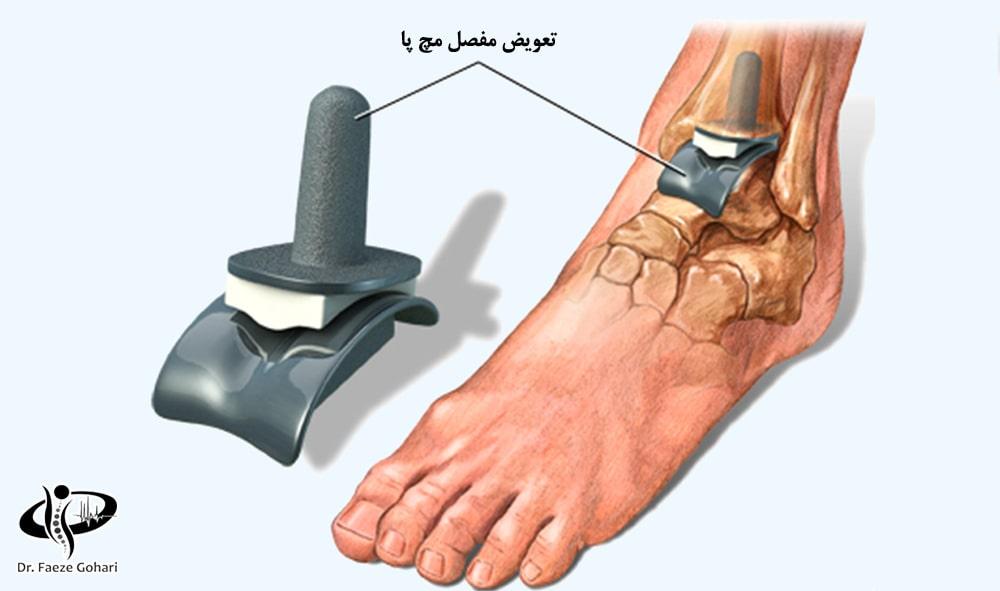 تعویض مفصل مچ پا