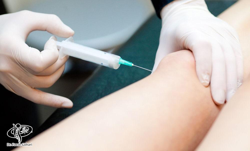 آرتروسنتز برای درمان مشکلات مفصل زانو