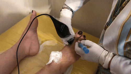 تزریق شست پا 