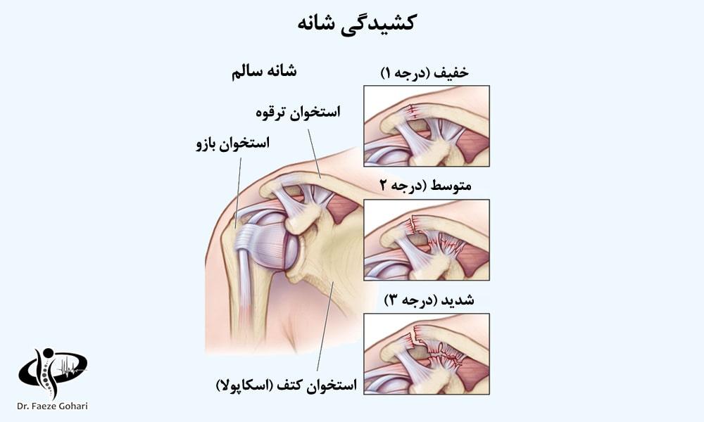 آسیبدیدگی رباطها