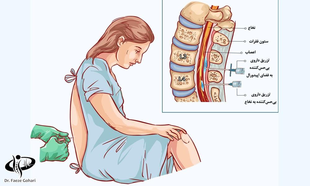 تزریق به فضای اپیدورال