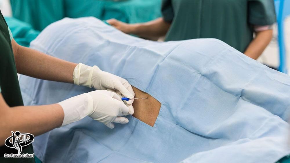 تزریق داروهای بلوک کنندهی عصب