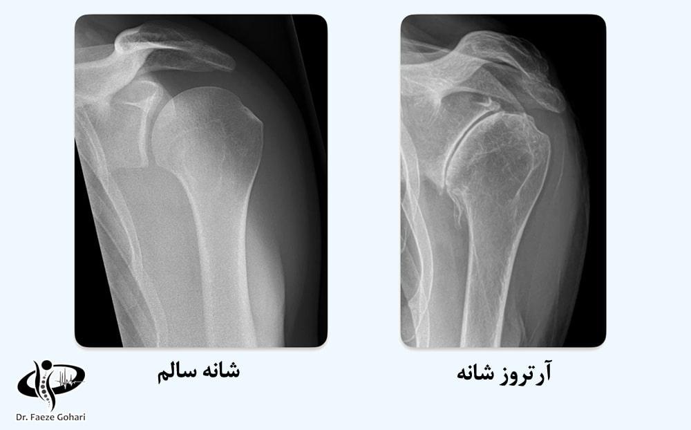 تزریق سلولهای بنیادی و PRP