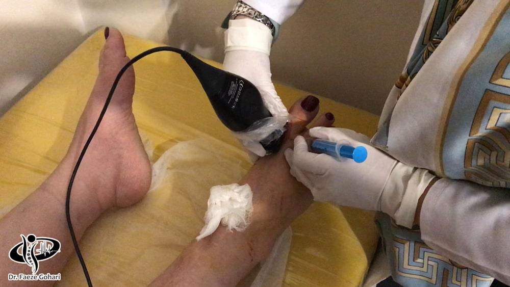 مراحل تزریق