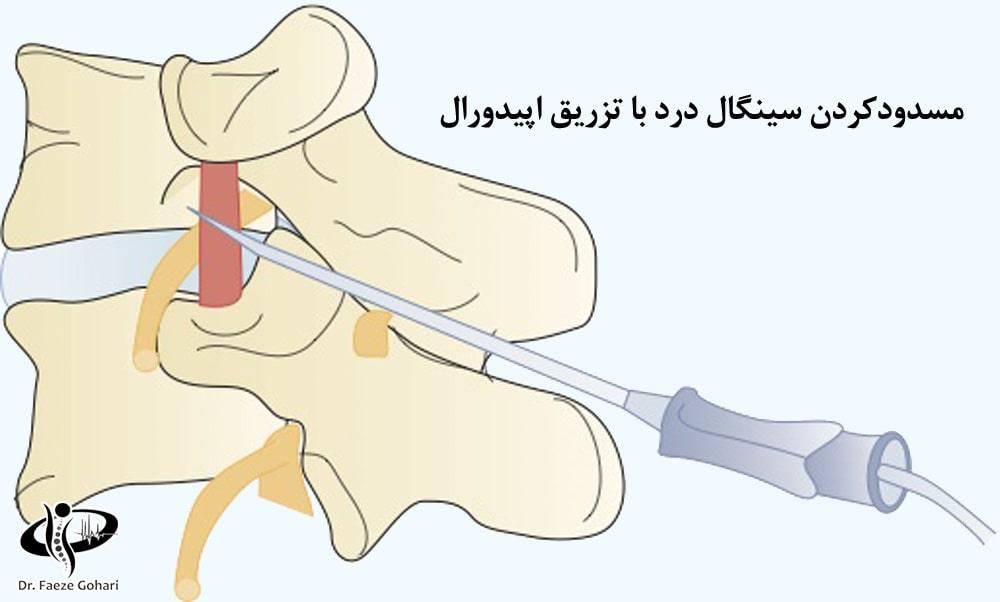 بلوک عصبی از طریق تزریق