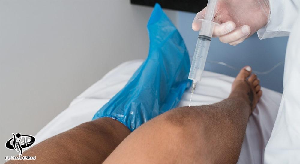 تزریق گاز اوزون به مفصل زانو