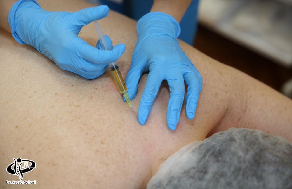 تزریق پیارپی