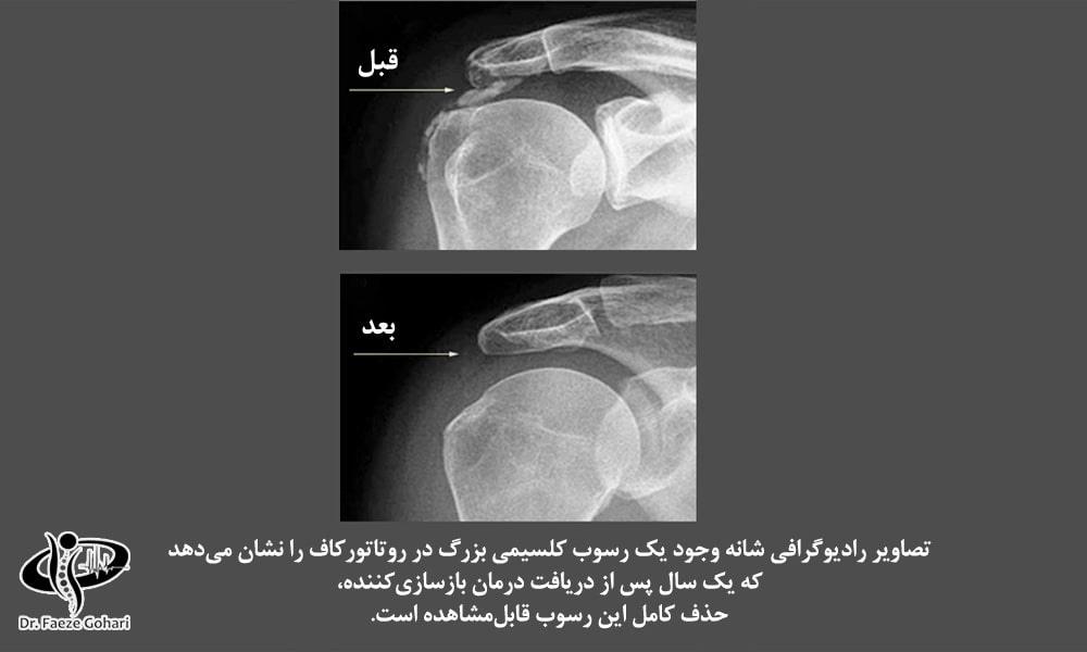 درمان همزمان روتاتورکاف و رسوبات کلسیمی