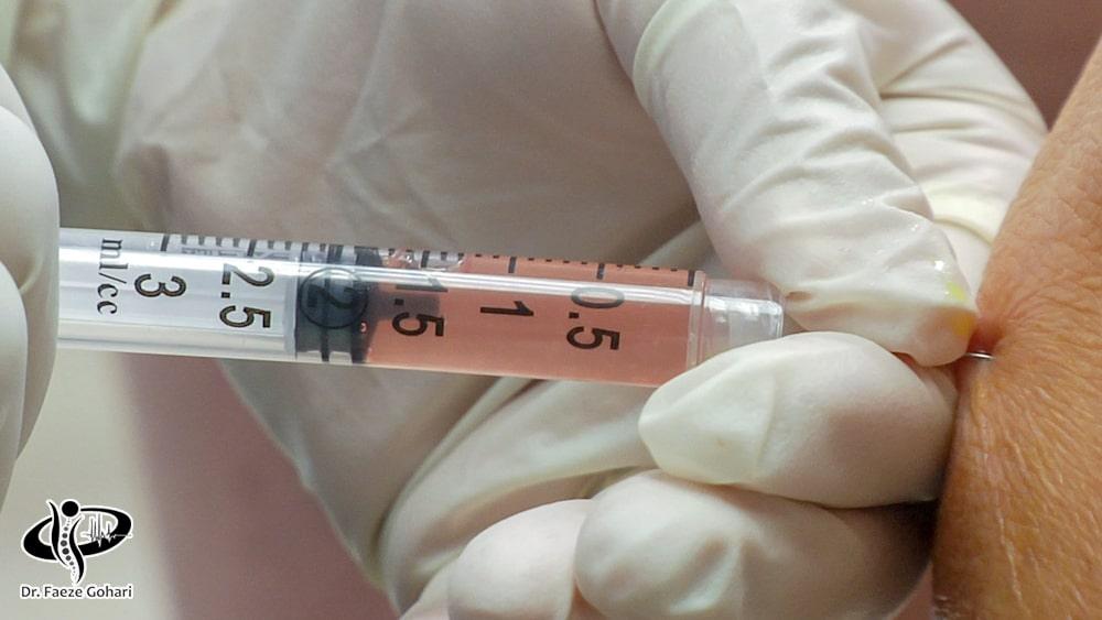 تزریق سلولهای بنیادی