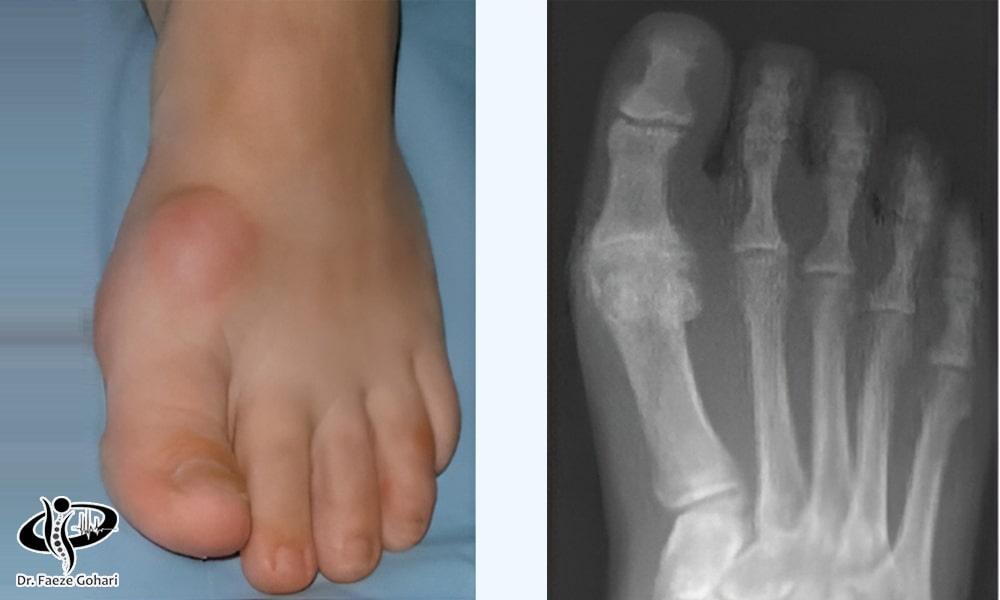 آسیب‌های قابل‌درمان همراه آرتروز شست پا 