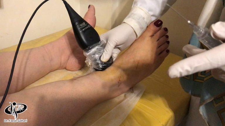 درمان آرتروز مچ پا با تزریق سلول‌های بنیادی و پی‌آرپی