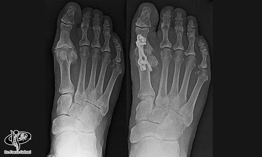 درمان آرتروز شست پا 