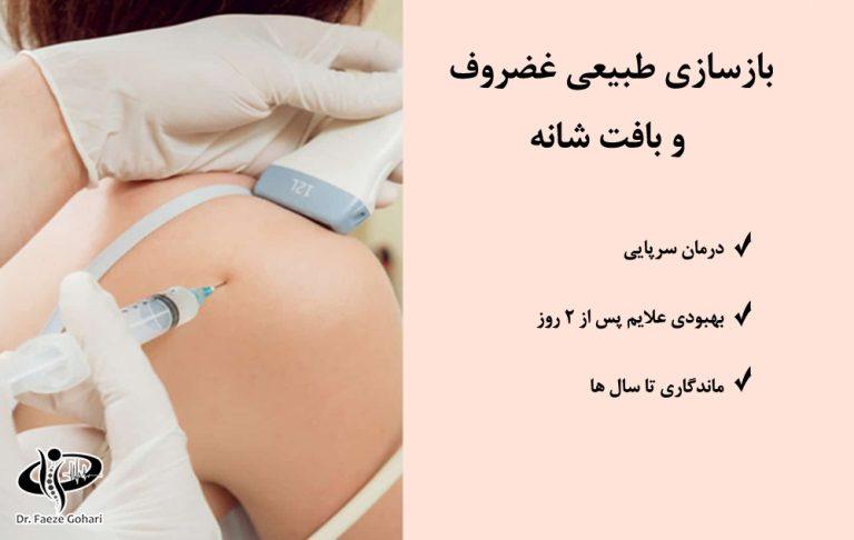 درمان آرتروز شانه با پی ار پی و سلول های بنیادی