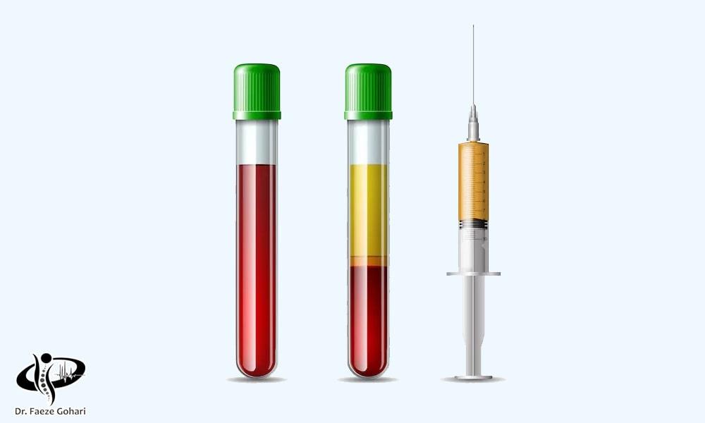 پلاسمای غنی از پلاکت (PRP)