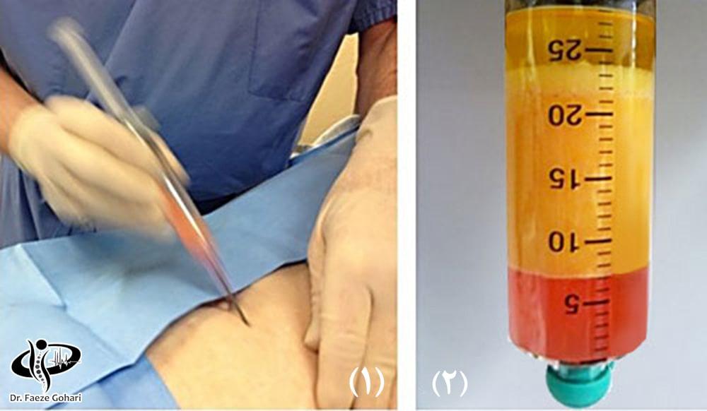 سلولدرمانی چیست؟