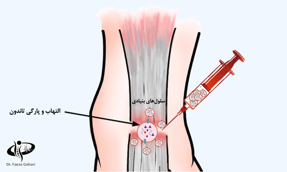 مزایای سلولدرمانی تاندون آشیل