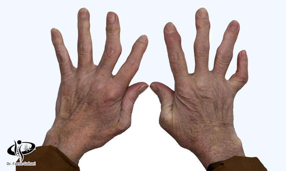 سلولدرمانی آرتروز مچ دست