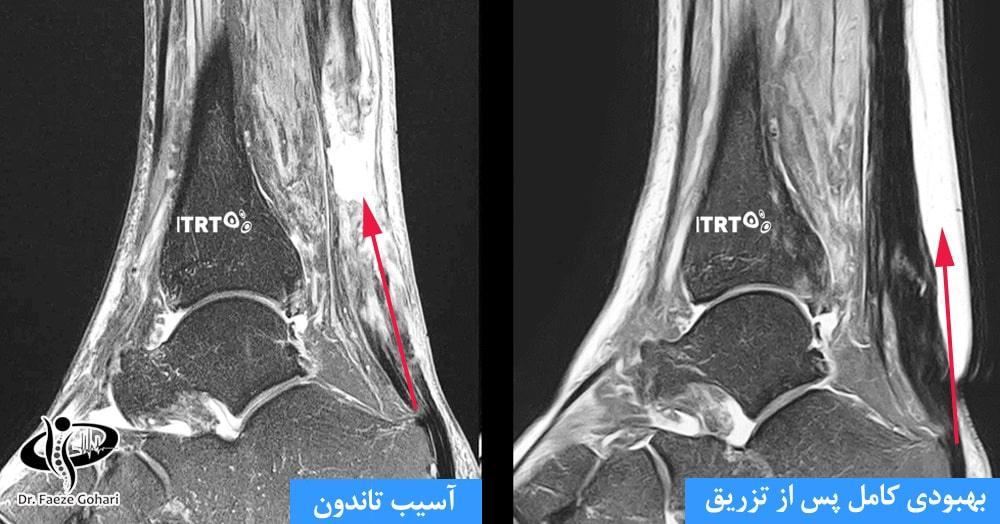 درمانهای نوین مانند تزریق PRP