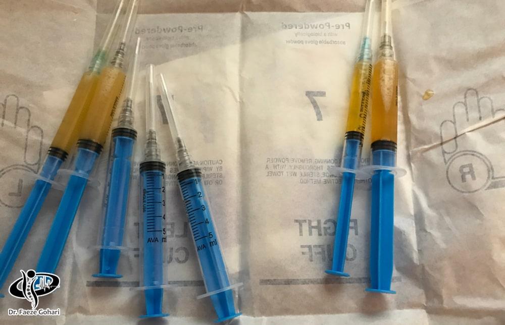 تهیه کوکتل تزریقی سلولهای بنیادی و پی آر پی