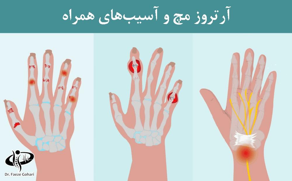 موفقیت سلولدرمانی در درمان آرتروز مچ