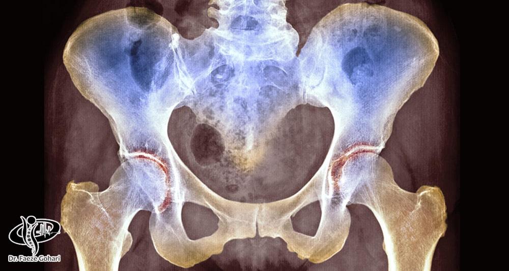 کاندیداهای مناسب برای سلول‌درمانی آرتروز لگن 