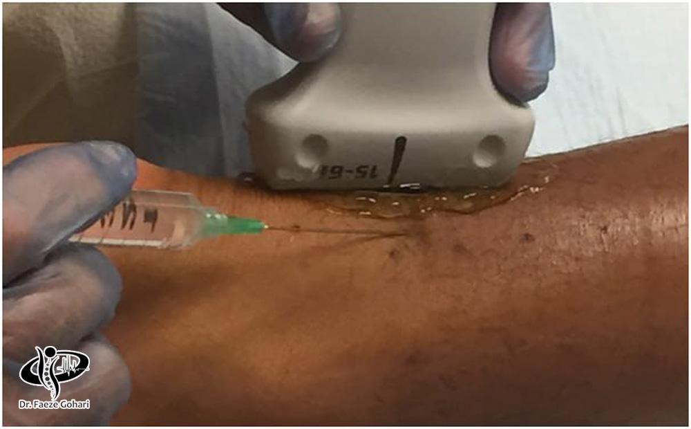 تزریق تحت هدایت سونوگرافی