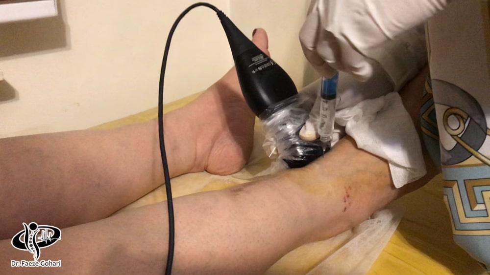 تزریق با هدایت سونوگرافی